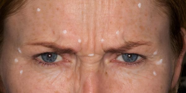 Case 1 Anti-wrinkle Before