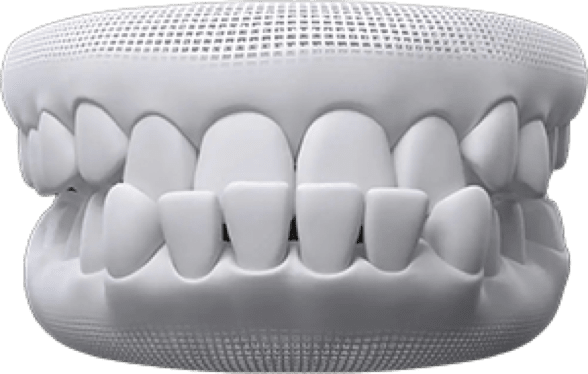 underbite
