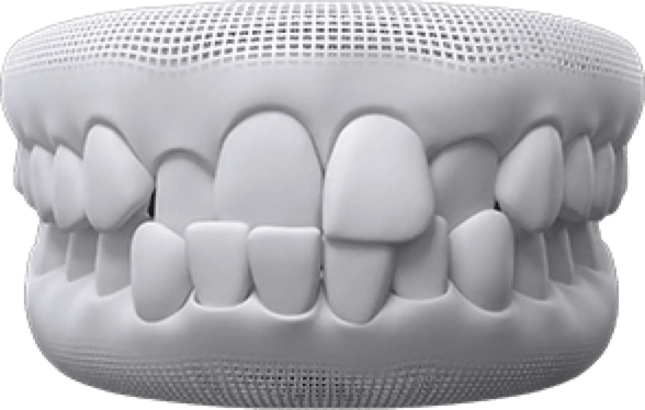 crossbite