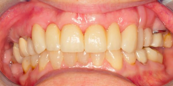 Case 2 Bridges & Veneers After