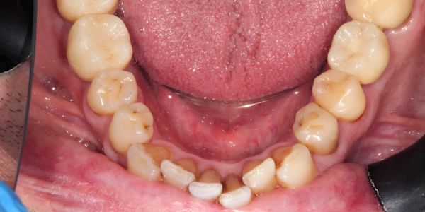Case 3 Dental Implants After