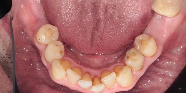Case 3 Dental Implants Before