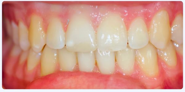 Case 5 Composite Filling After